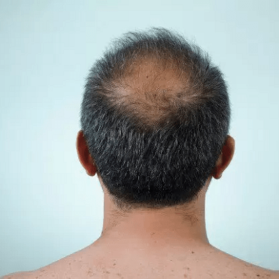 Hair Transplant Can Give You A Permanent Natural Look in Dubai Cost