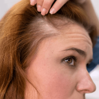 Is Hair Regrowth Possible In Female in Dubai