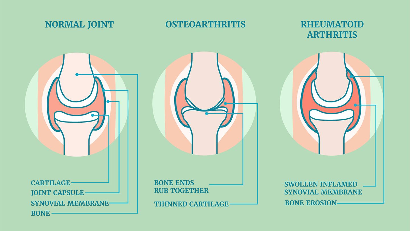 Joint Pain And Arthritis infographic in Dubai