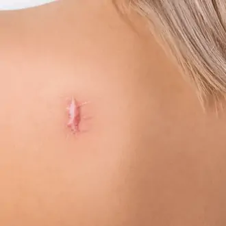 Keloids No More: Discover Effective Treatment