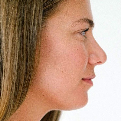 Non-Invasive Rhinoplasty: Enhancing Your Nose Without Surgery