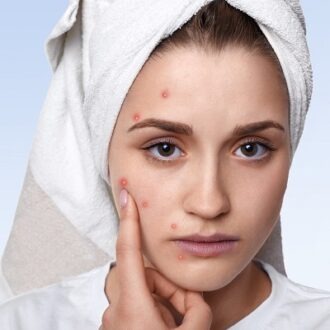 Say Goodbye To Acne: Expert Tips For A Flawless Complexion