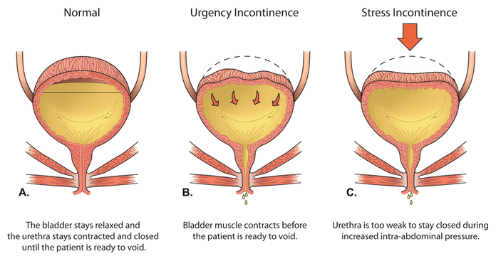 Stress Incontinence Treatment infographic in Dubai