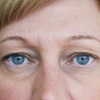 Tips For A Faster Recovery After Eyelid Surgery