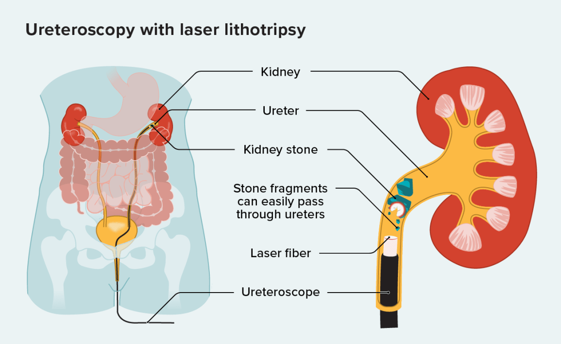 Ureteroscopic Lithotripsy Procedure infographic in Dubai
