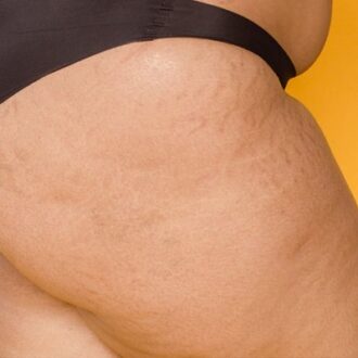 What Causes Stretch Marks On Buttocks?