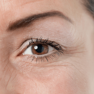 Why Are Some People Not Able to Close Their Eyes after Eyelid Surgery?