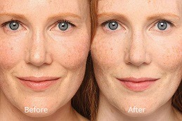 Belotero Fillers in Dubai