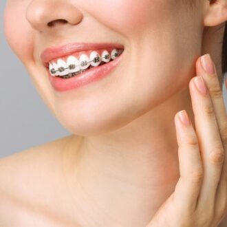 Do Braces Move Your Teeth Every Day?