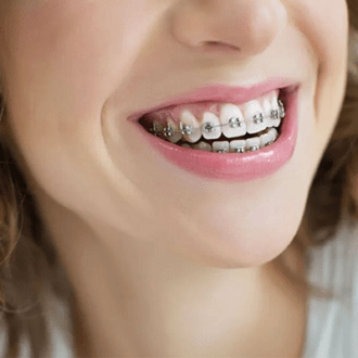 Do Dentists Whiten Teeth After Braces?