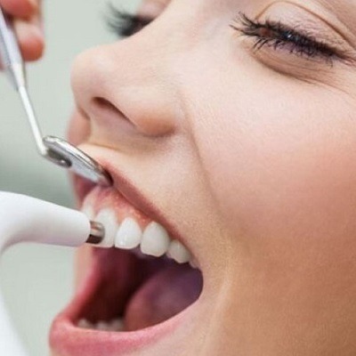 Is Scaling And Polishing Good For Teeth in Dubai