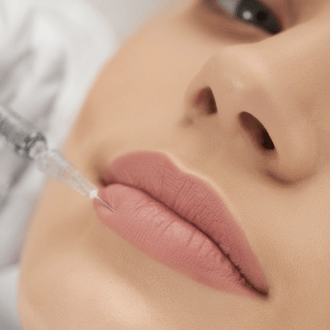Lip Fillers For Gummy Smile