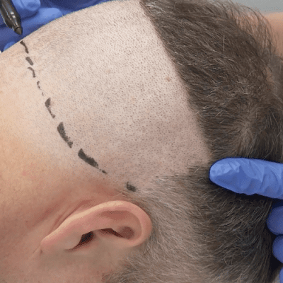 Say Goodbye To Baldness And Hello To Confidence in Dubai Cost