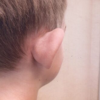 What You Need To Know About Ear Reshaping