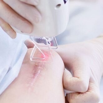 CO2 Laser For Hypertrophic Scars in Dubai