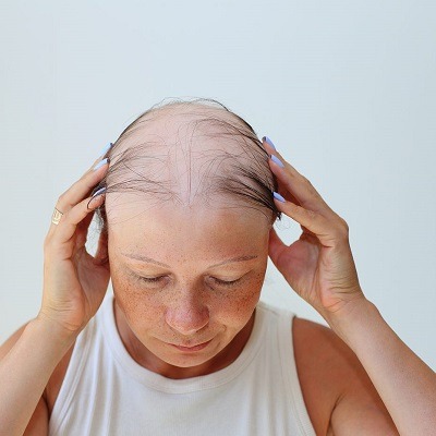 Female Hair Baldness Treatment Cost Dubai