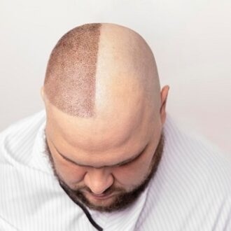 Hair Transplant Cost In Abu Dhabi
