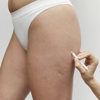 How Do I Get Rid Of Cellulite On My Buttocks?