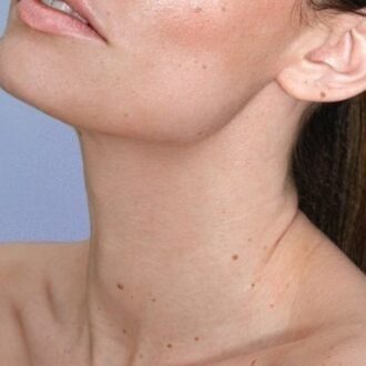 Neck Lift Surgery: Cosmetic Procedure & Recovery