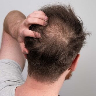 Can Hair Transplant Cure Genetic Baldness?