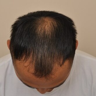 Can I See The Result Of PRP After One Session?