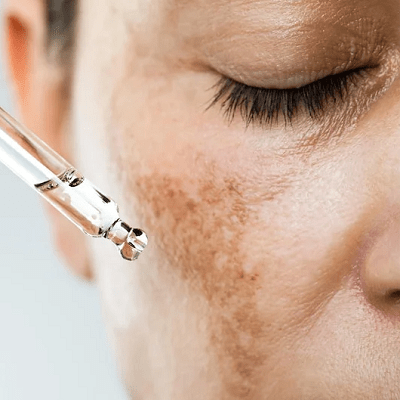 Can Laser Hair Removal Cause Hyperpigmentation