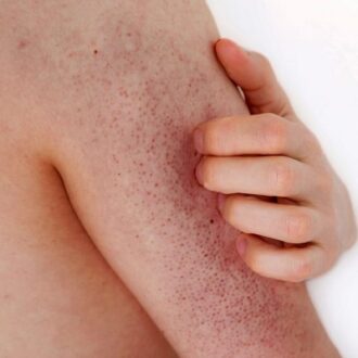 Exploring The Benefits Of Treating Keratosis