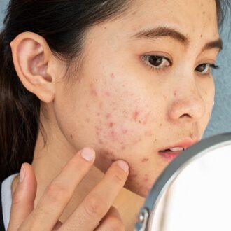 Facial Scars: Types Of Scars And Their Treatments