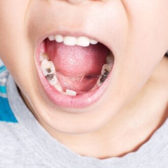 How Long Does A Tooth Filling Last?