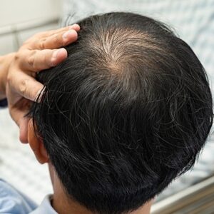 Are Hairline Transplants Effective?