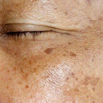 Can Melasma Treatment Completely Remove Dark Spots?
