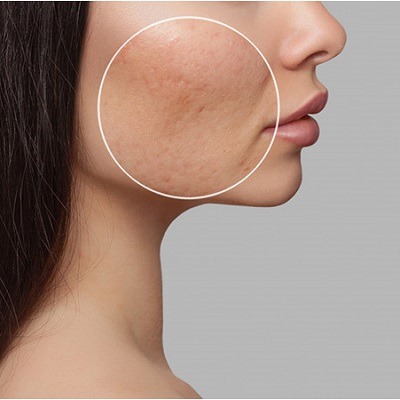 Exploring The Benefits Of Acne Scar Treatment