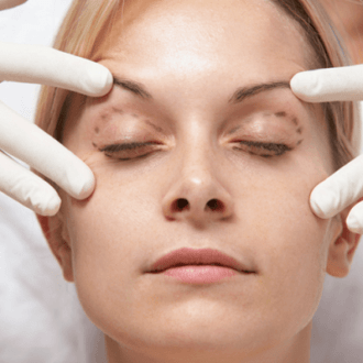 Upper And Lower Blepharoplasty In Dubai