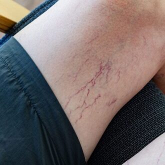 Red Light Therapy For Spider Veins