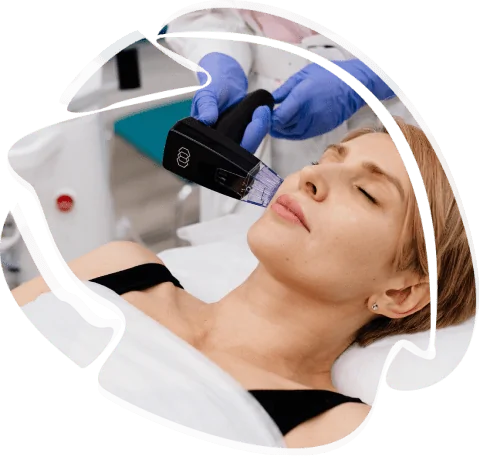 Morpheus 8 treatment