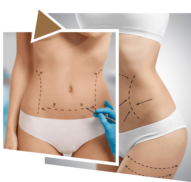 Liposuction Surgery in Dubai​ and Abu Dhabi