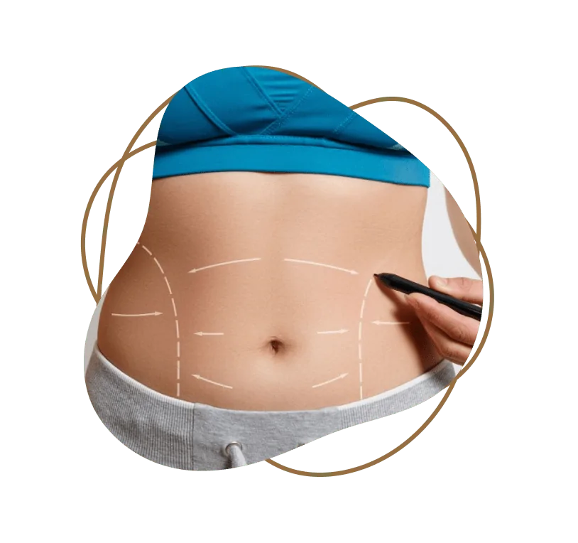 Liposuction in Dubai​