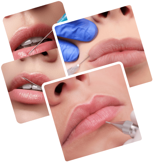 Russian Lip Fillers Dubai
