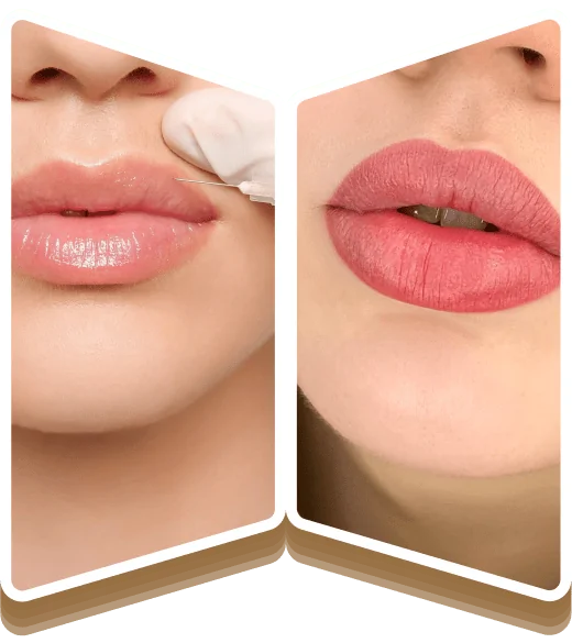 Russian Lip Fillers Dubai
