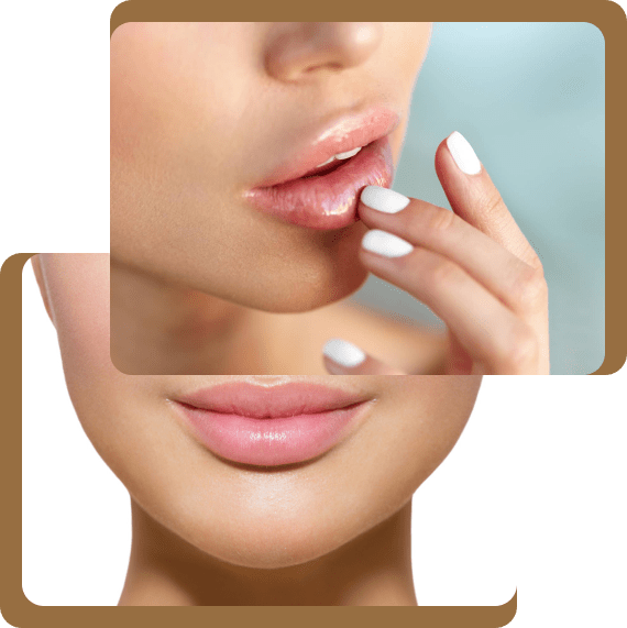 Russian Lip Fillers in Dubai