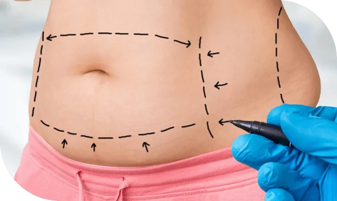Best Liposuction Surgery Dubai​