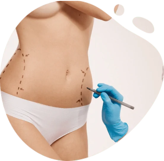 Liposuction in Dubai​ UAE