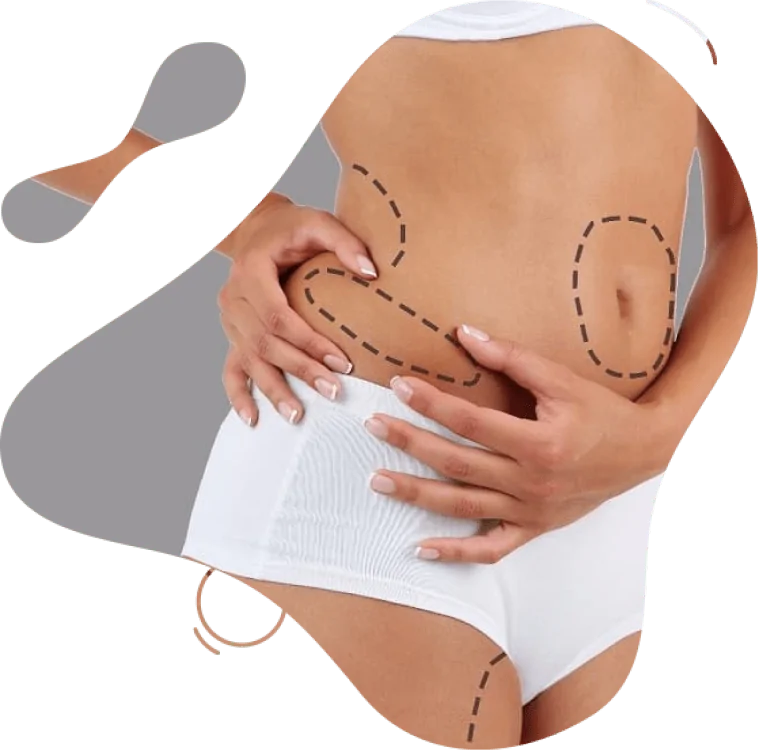 Liposuction Surgery Dubai​