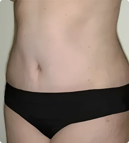 Best Liposuction in Dubai​ and Abu Dhabi