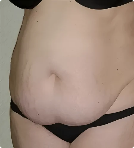 Liposuction in Dubai​ and Abu Dhabi