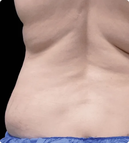 Liposuction Surgery