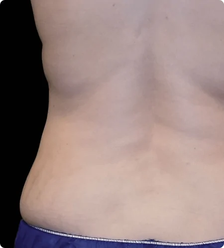 Best Liposuction Surgery
