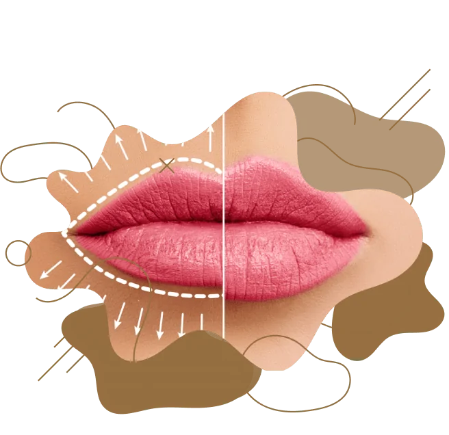 Russian Lip Fillers in Dubai