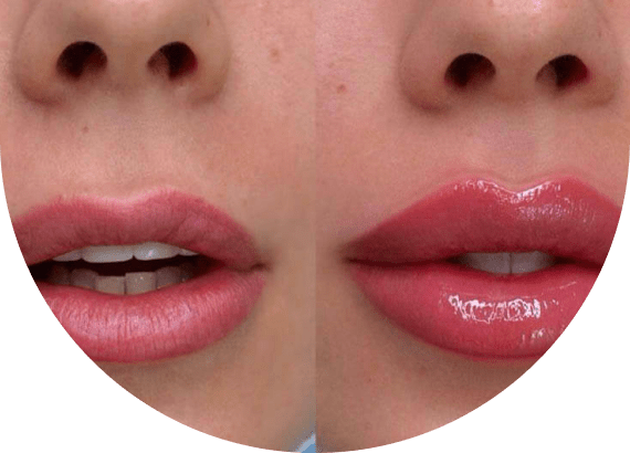 Russian Lip Fillers Dubai