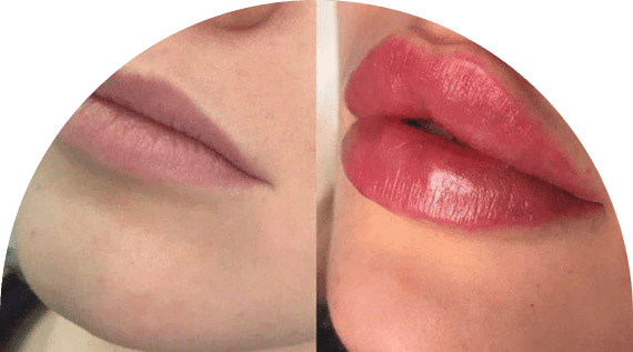 Russian Lip Fillers